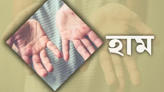 হাম রোগের সর্বশেষ প্রতিবেদন