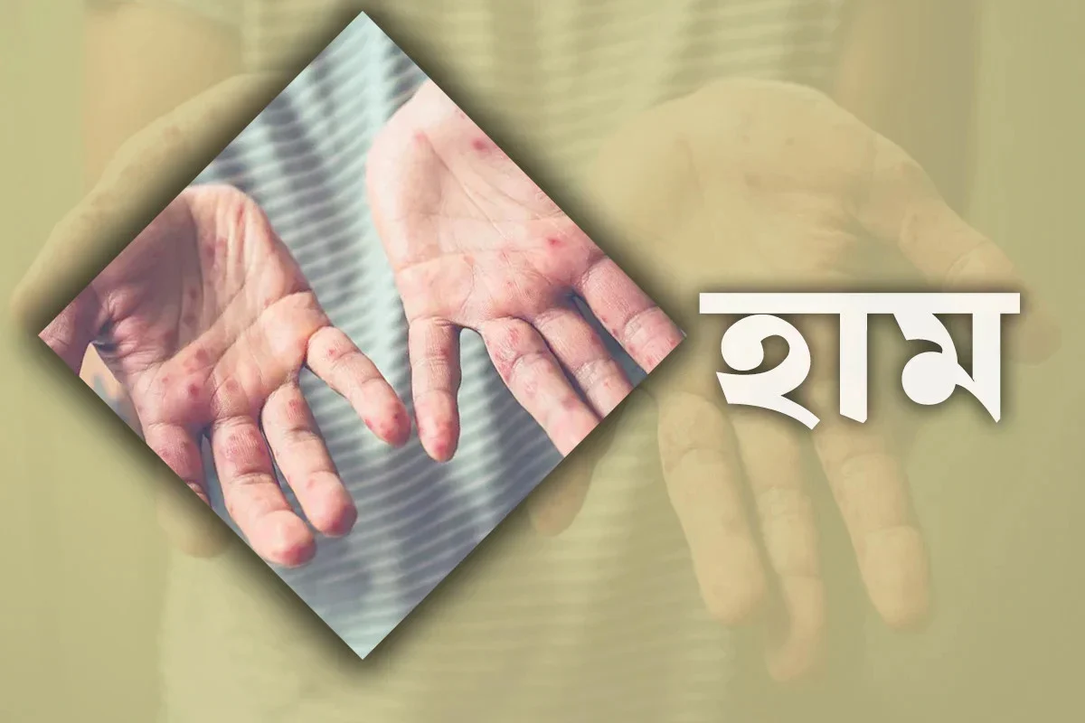 হাম রোগের সর্বশেষ প্রতিবেদন