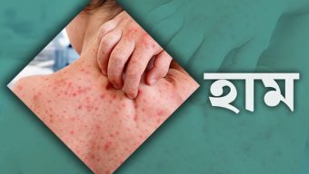 হাম রোগের সর্বশেষ প্রতিবেদন