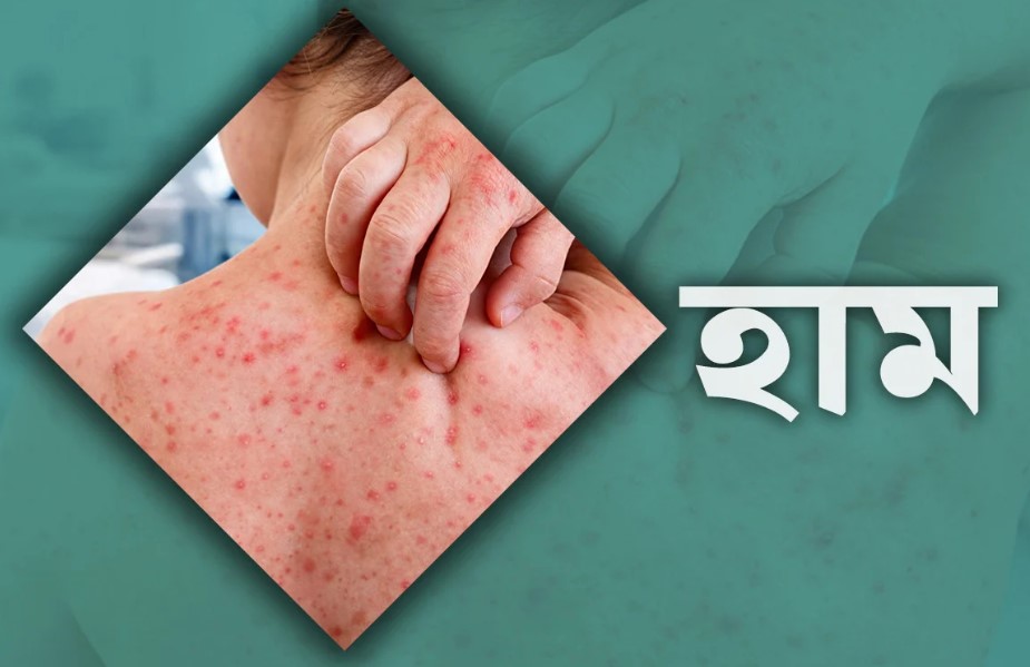 হাম রোগের সর্বশেষ প্রতিবেদন
